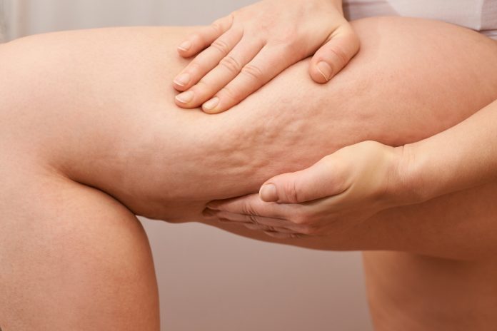 Cellulite Beinfrau kneifen. Behandlung von Fetthüftgelenken testen. Fettabsaugung bei Übergewicht. Striae entfernen.
