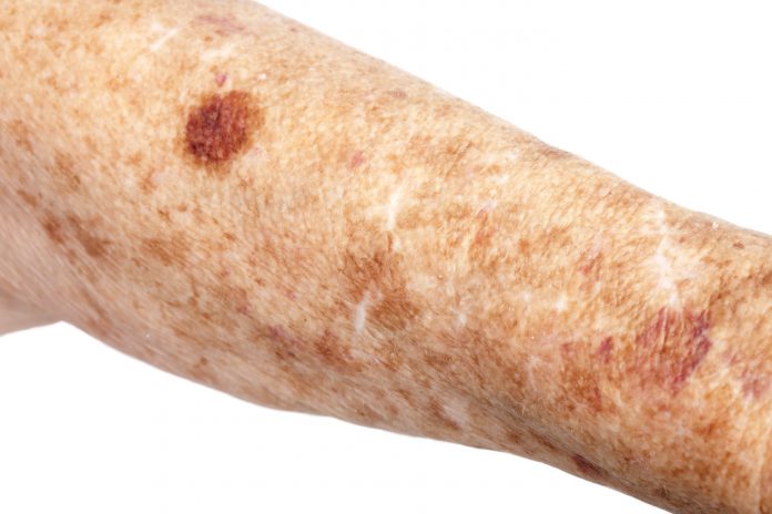 Female senior citizen arm with  age spots (also known as liver spots, Solar lentigo, Lentigo senilis and Senile freckle) shot on a white background. The large dark bruise (contusion or hematoma of tissueis) caused buy blood thinning medication making the skin bruise easly,