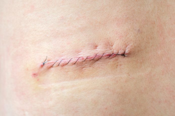stitched up scar on back agter surgery