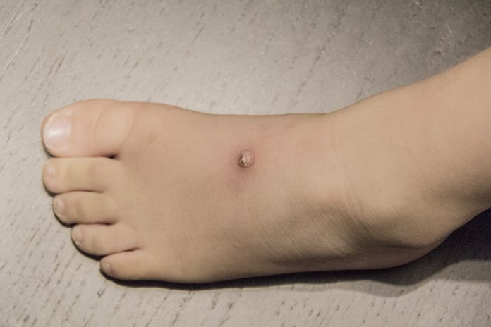 a young boy with a wart on his foot