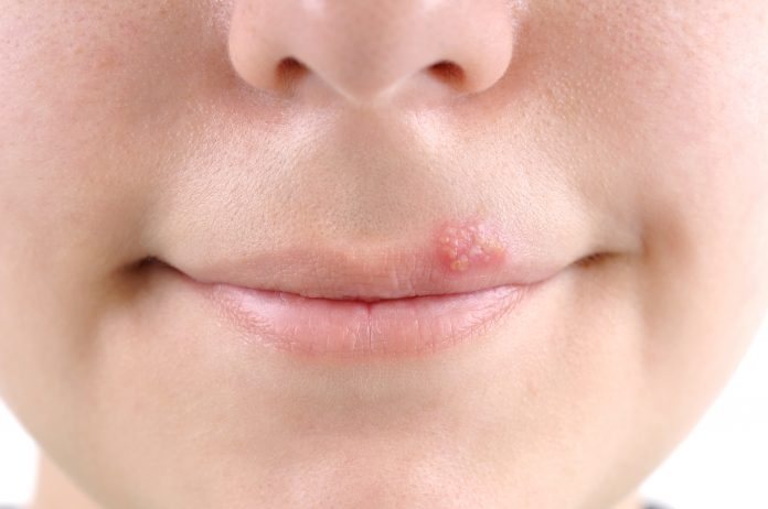 Close up of lips affected by herpes - a series of MEDICAL related images.