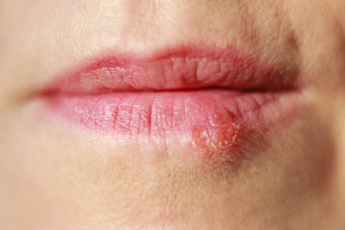 Close-up of woman's lips with cold sores