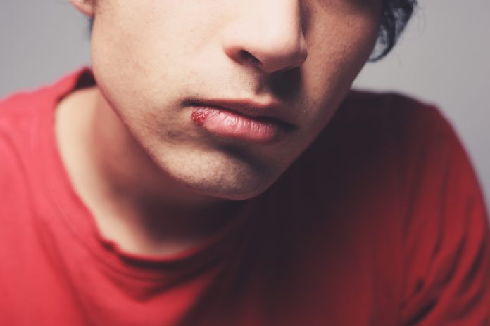 Young man with a cold sore on his lip