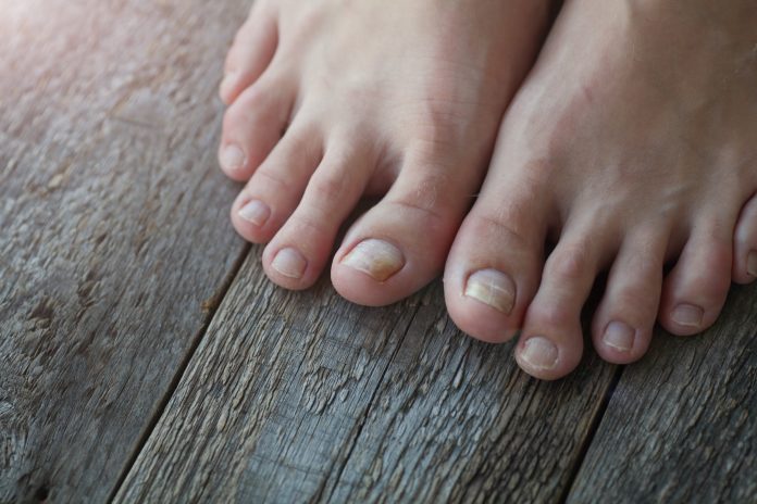 Close-up of legs with fungus on nails on wooden background. Onycholysis: exfoliation of the nail from the nail bed.