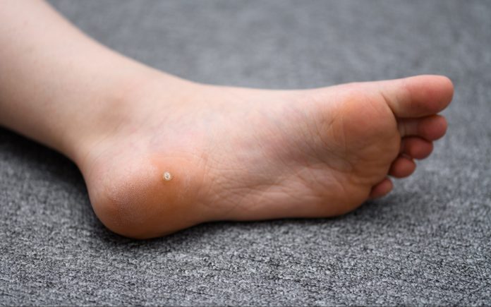 Foot wart, verrucas plantar on the foot of a child from Sweden. A  decease caused by the Human papillomavirus (HPV) and often spread at communal showers or by sharing socks with others.
